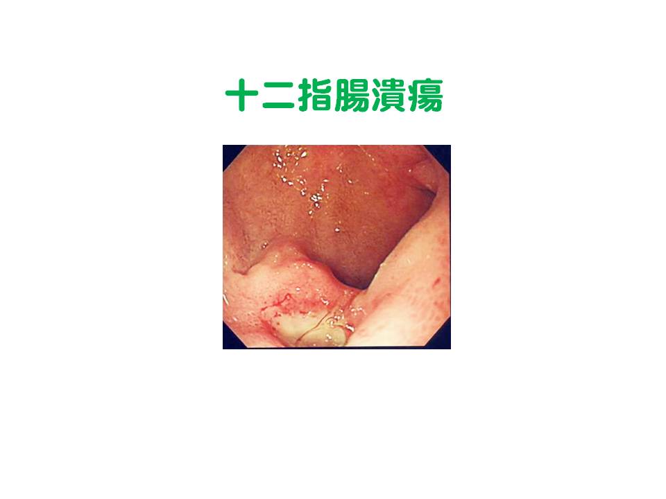 7）十二指腸潰瘍