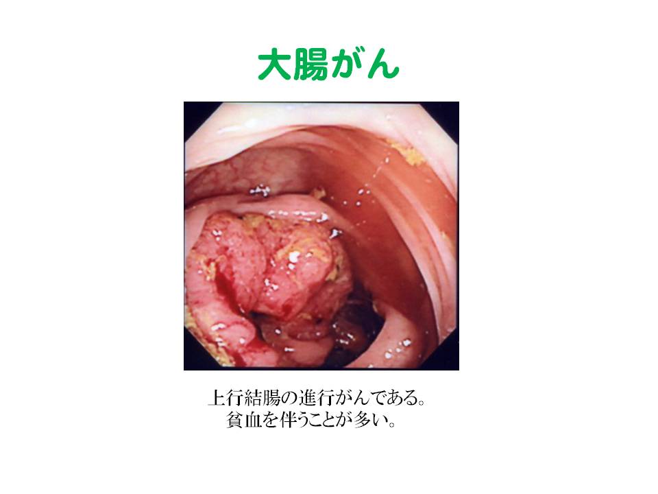 4）大腸がん