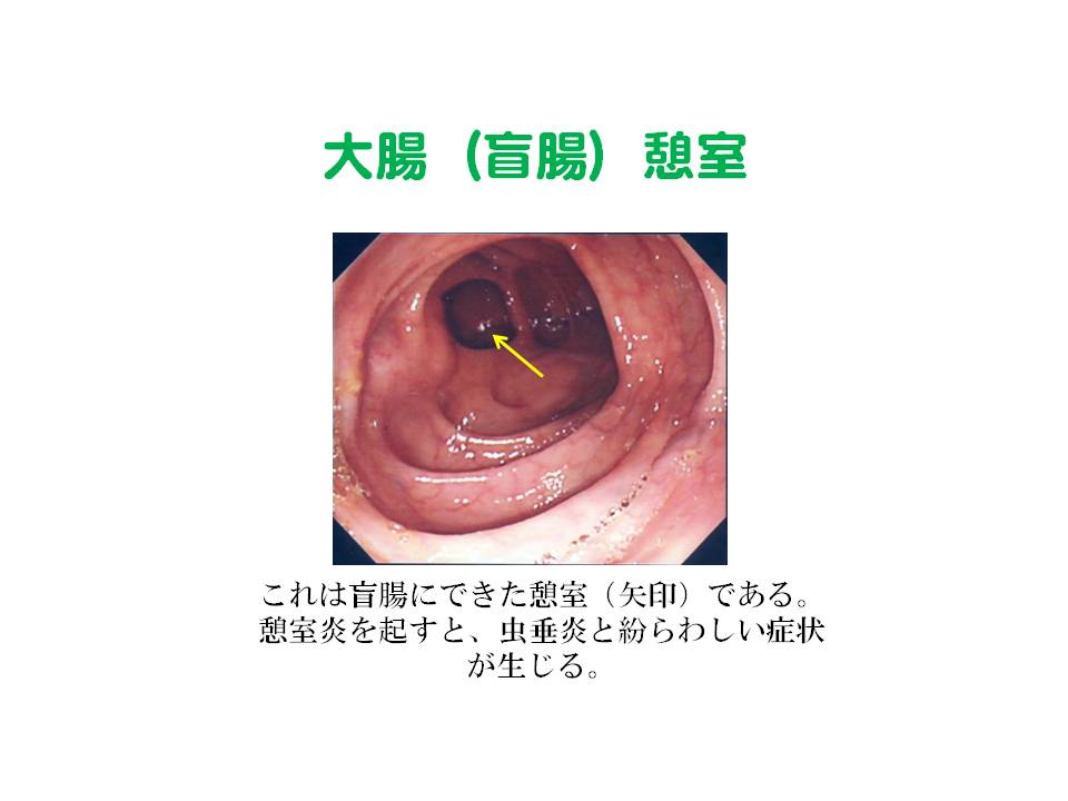 5）大腸憩室