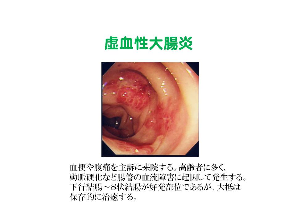 6）虚血性大腸炎