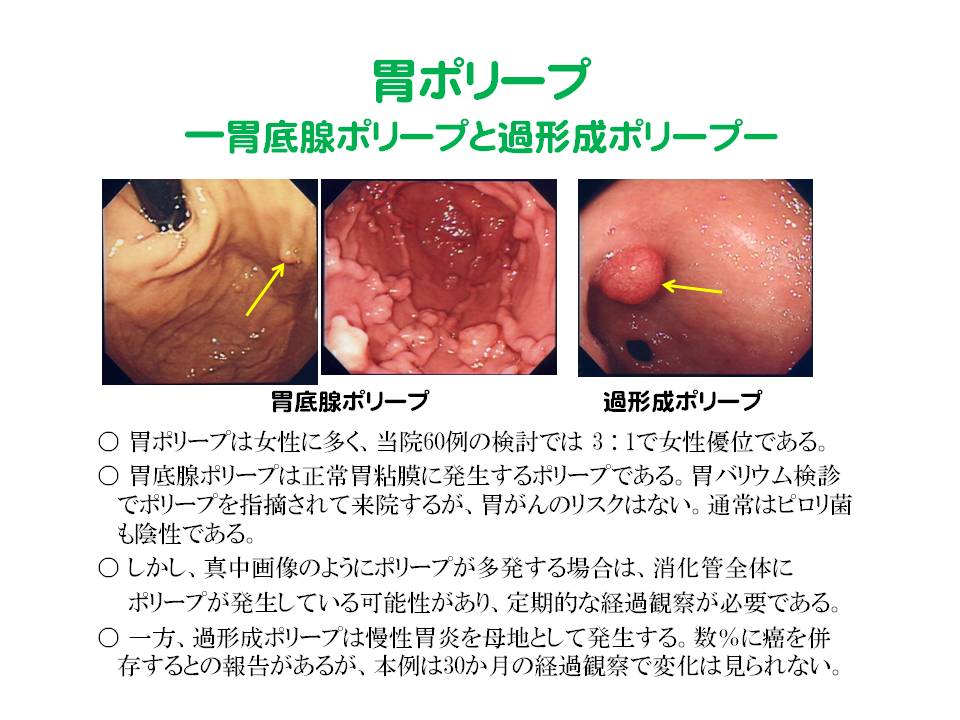 4）胃ポリープ