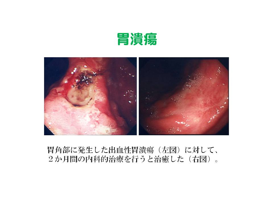 6）胃潰瘍